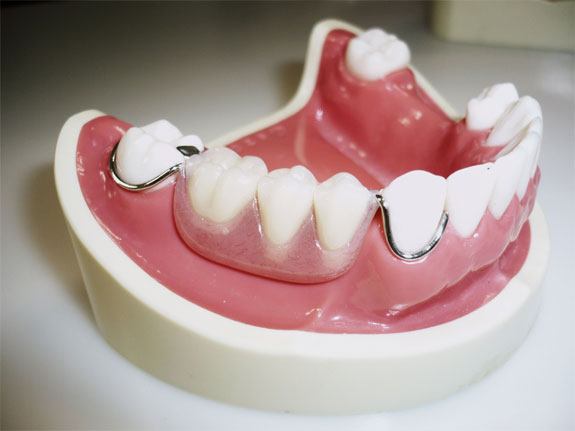 写真：レジン床義歯